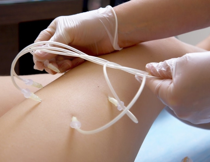 Озонотерапия - Оздоровительные услуги - Санаторий «Целебный ключ» Ессентуки